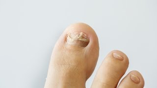 How to prevent and treat nail fungus [upl. by Airdnaxila741]