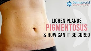 How to cure Lichen Planus Pigmentosus  Lichen Planus Pigmentosus Treatment  Dr Rohit Batra [upl. by Alrak372]