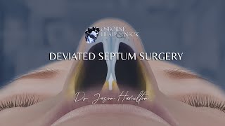 Deviated Septum Surgery [upl. by Naraj918]