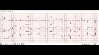 Basic EMS 12Lead and STEMI Identification Part 1 [upl. by Elery]