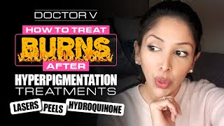 Doctor V  How To Treat Burns after Hyperpigmentation Treatments  Skin of Colour [upl. by Akemak]