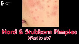 How to get rid of hard pimples  Dr Nischal K [upl. by Plato]