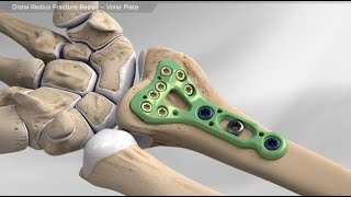 Fracture Healing  ANIMATION  BASICS  The Young Orthopod [upl. by Yrffoeg]