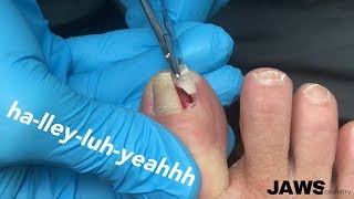 REMOVING A LARGE INGROWN TOENAIL [upl. by Yendor]