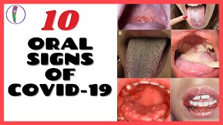 ORAL SIGNS OF CORONAVIRUS COVID 19  CORONAVIRUS SYMPTOMS [upl. by Hilleary]