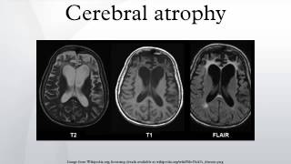 Cerebral atrophy [upl. by Anawqahs]