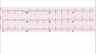 Lead reversal and Dextrocardia ECG explanation [upl. by Rosinski]