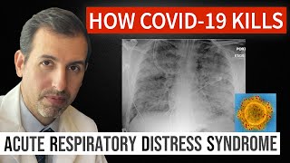 How Coronavirus Kills Acute Respiratory Distress Syndrome ARDS amp COVID 19 Treatment [upl. by Airret]