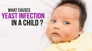 What causes yeast infection in a child  SKIN INFECTIONS  FUNGAL INFECTIONS [upl. by Eisned]