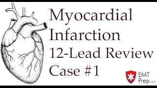 Case 1  Acute MI  Reading 12Lead ECGs  EMTprepcom [upl. by Ellehcyt]