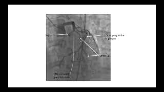 Ventricular Fibrillation during Left Ventriculography [upl. by Diamante]