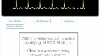 ECG Rhythm Review of 14 common rhythms [upl. by Euqinehs185]