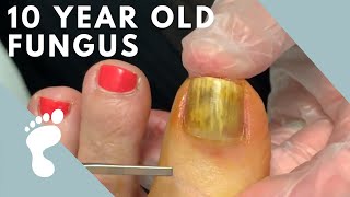 Fungus Takes Over Toenail  Toenail Removal [upl. by Anirac]