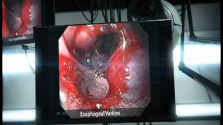 Esophageal Varices [upl. by Balcer]