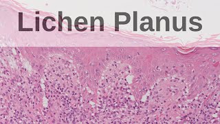 Lichen Planus  Pathology mini tutorial [upl. by Mikes87]