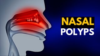 NASAL POLYPS Causes SIgns and Symptoms Diagnosis and Treatment [upl. by Ridan]