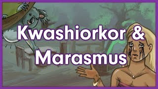 Kwashiorkor vs Marasmus  Nutrition Mnemonic [upl. by Normac]