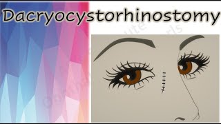 Dacryocystorhinostomy  DCR [upl. by Varhol221]