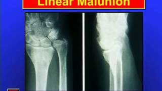 Distal Radius Fractures [upl. by Pacien370]