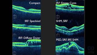 Macular OCT Interpretation A Practical Discussion with Dr David E Lederer [upl. by Kimbra]