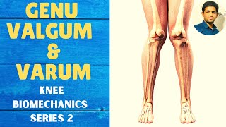 GENU VALGUM amp GENU VARUM  Knee Complex Biomechanics [upl. by Ahsenor]