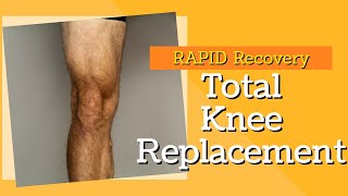 Your guide to knee replacement surgery  13  Day 1 amp 2 after your operation [upl. by Suirad]