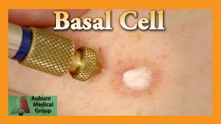 Basal Cell Cryotherapy Treatment  Auburn Medical Group [upl. by Donald176]