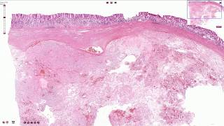 Gastrointestinal Stromal Tumor GIST  Histopathology [upl. by Pia777]