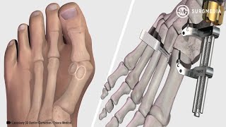 Flexor hallucis longus strengthening [upl. by Neiluj586]