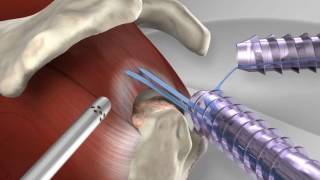 Knotless Rotator Cuff Repair with Arthrex® SpeedFix™ [upl. by Sidell539]